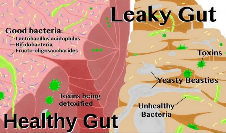 Leaky what? Is the problem in your gut?