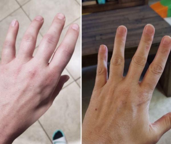 Jenn’s painful, swollen hands before at left and flexible, pain-free fingers after at right.